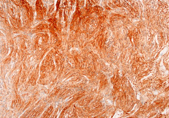 1C1 Meningioma, fibrous, intraventricular  (Case 1) EMA 10X 2