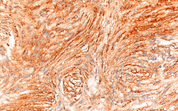 1C2 Meningioma, fibrous, intraventricular  (Case 1) EMA 40X 2