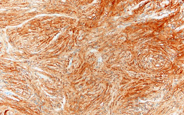 1C3 Meningioma, fibrous, intraventricular  (Case 1) EMA 20X 2