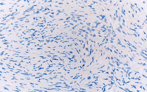 1D Meningioma, fibrous, intraventricular  (Case 1) PR 40X