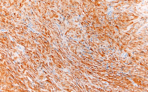 1E1 Meningioma, fibrous, intraventricular  (Case 1) S100 20X