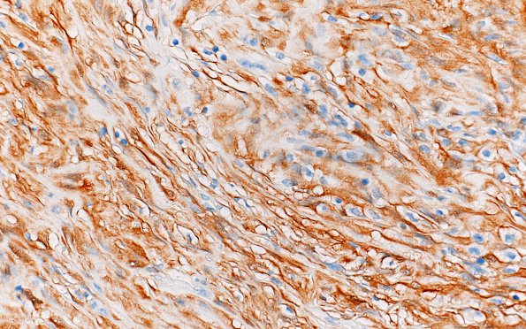 1E2 Meningioma, fibrous, intraventricular  (Case 1) S100 40X