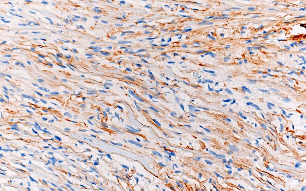 1F Meningioma, fibrous, intraventricular  (Case 1) Coll IV 40X