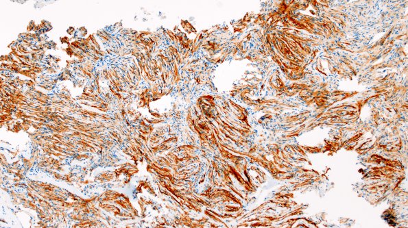 1G1 Meningioma, fibrous, intraventricular  (Case 1) SSTR2 10X 2