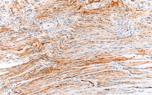 1G2 Meningioma, fibrous, intraventricular  (Case 1) SSTR2 20X 2 (2)