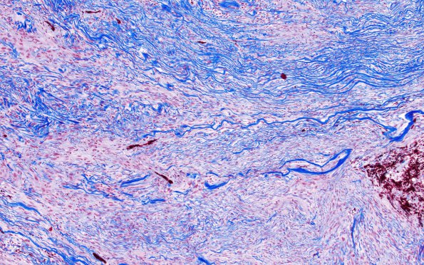 1H1 Meningioma, fibrous, intraventricular  (Case 1) Trichrome 10X