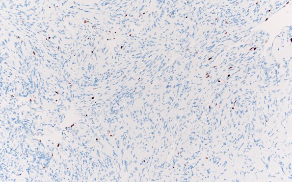 1I Meningioma, fibrous, intraventricular  (Case 1) Ki67