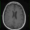 2A1 Meningioma (Case 2) T1 1 - Copy