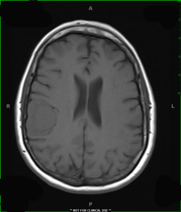 2A1 Meningioma (Case 2) T1 1 - Copy