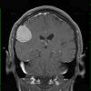 2A2 Meningioma (Case 2) T1 W 1 - Copy