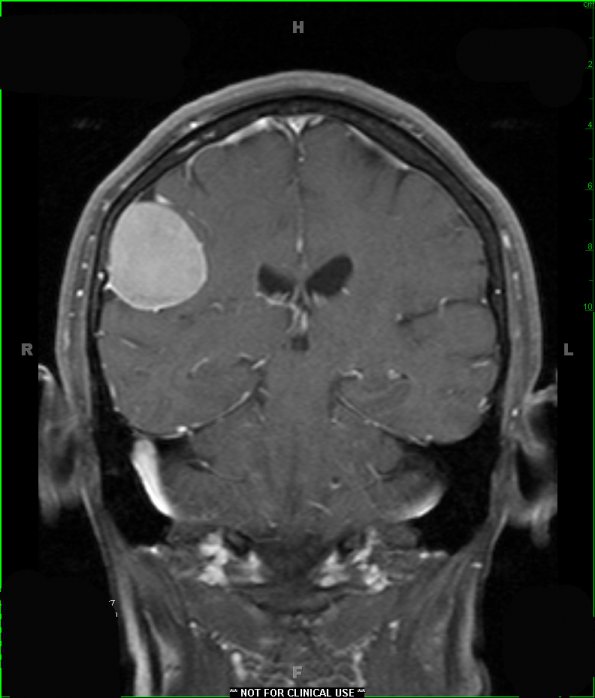 2A2 Meningioma (Case 2) T1 W 1 - Copy