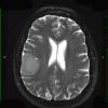 2A3 Meningioma (Case 2) T2 W 1 - Copy