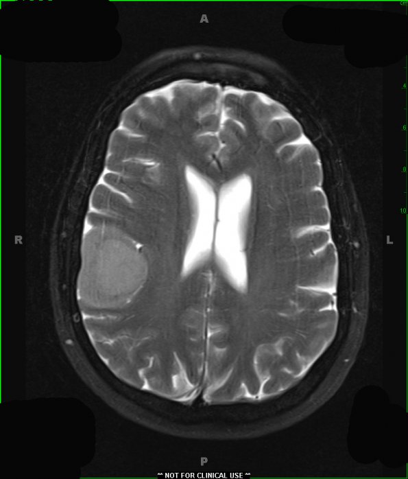 2A3 Meningioma (Case 2) T2 W 1 - Copy