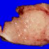 2B Meningioma (Case 2) Gross _2