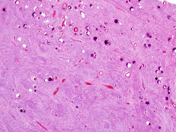 2C1 Meningioma (Case 2) H&E 2