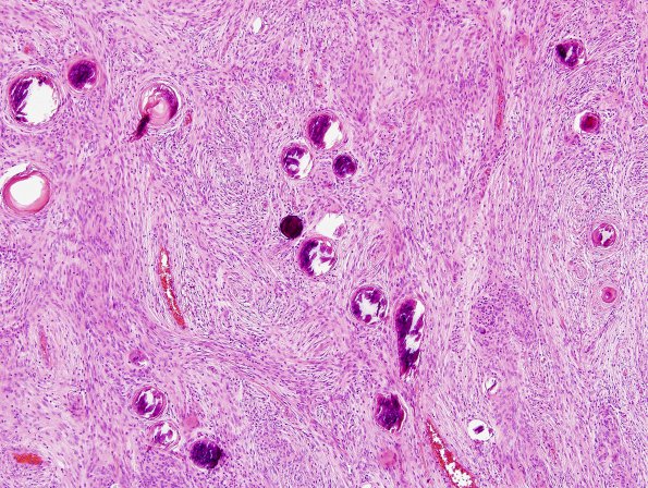 2C2 Meningioma (Case 2) H&E 3