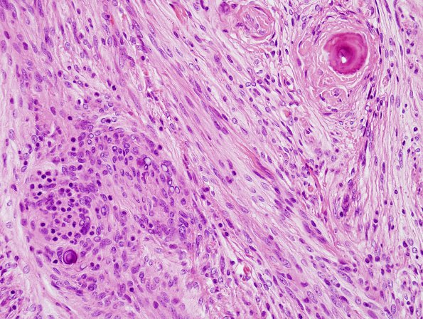 2C3 Meningioma (Case 2) H&E 4