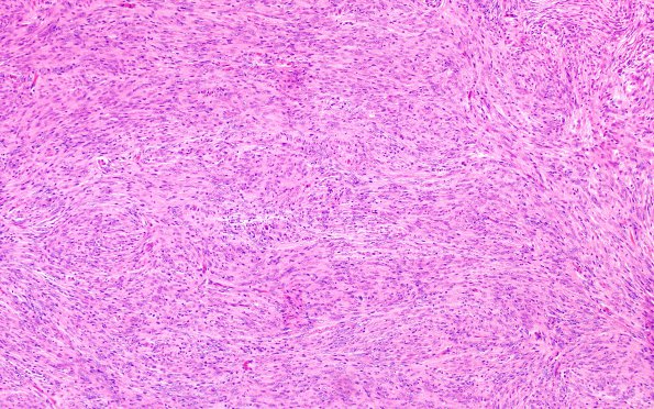 3A1 Meningioma (Case 3) H&E 10X 1