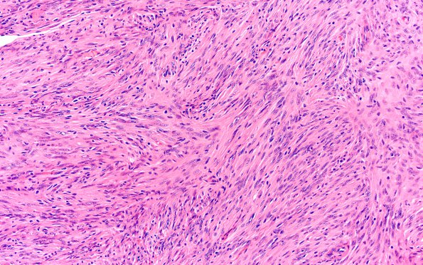 3A2 Meningioma (Case 3) H&E 20X