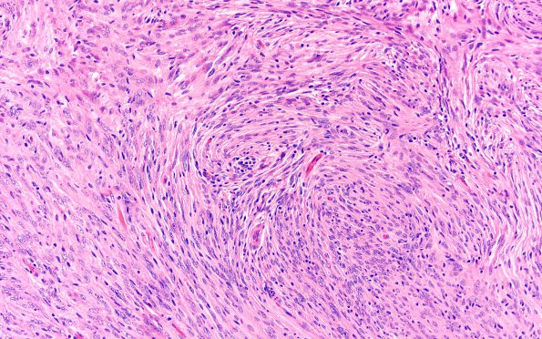 3A3 Meningioma (Case 3) H&E 20X 1