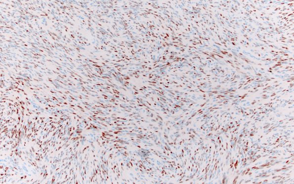 3B2 Meningioma (Case 3) PR 20X 2