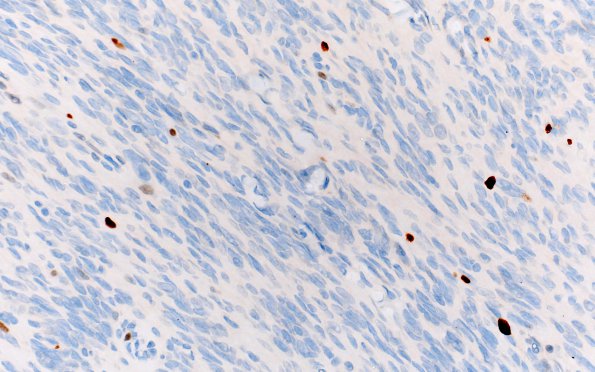 3C1 Meningioma (Case 3) Ki67 10X 1