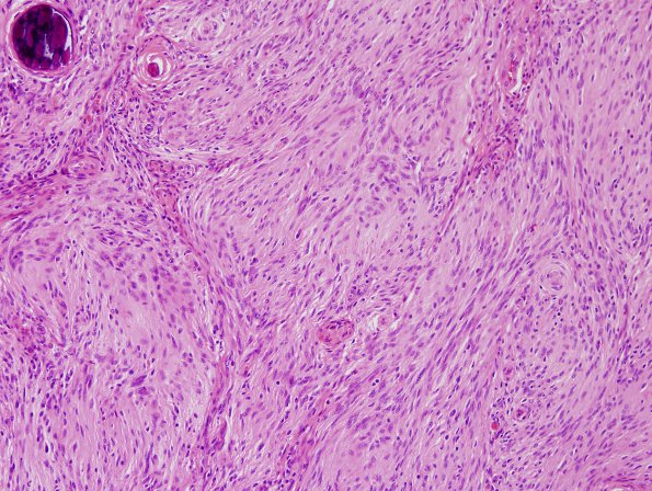 4A Meningioma (Case 4) H&E 1.jpg