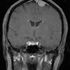 5A1 Meningioma, transitional (fibrous) (Case 5) T1 W 1 - Copy