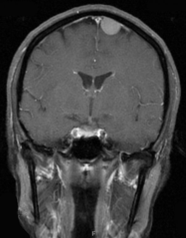 5A1 Meningioma, transitional (fibrous) (Case 5) T1 W 1 - Copy