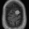 5A2 Meningioma, transitional (fibrous) (Case 5) T1 W 3 - Copy