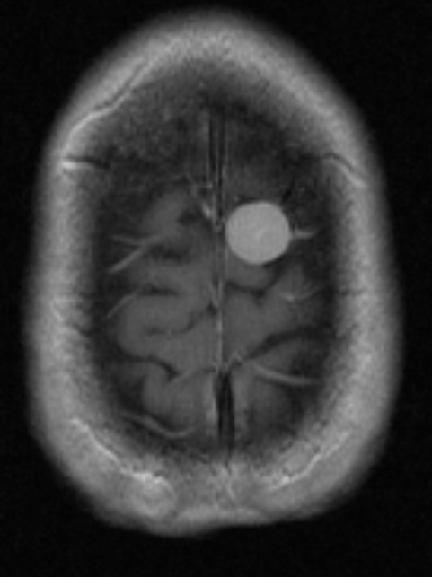 5A2 Meningioma, transitional (fibrous) (Case 5) T1 W 3 - Copy