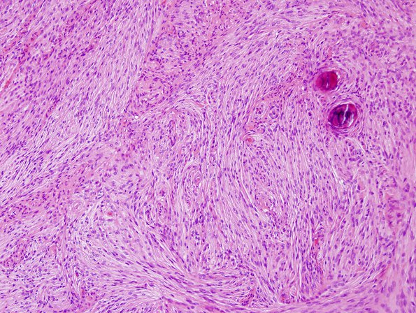 5B1 Meningioma, transitional (fibrous) (Case 5) H&E 2.jpg