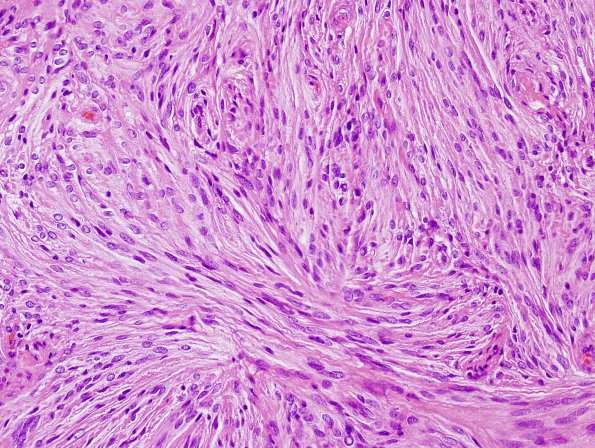 5B2 Meningioma, transitional (fibrous) (Case 5) H&E 3.jpg