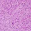 5B3 Meningioma, transitional (fibrous) (Case 5) H&E 4.jpg