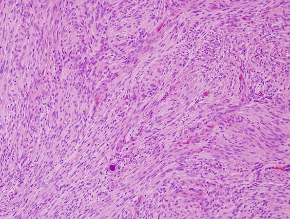 5B3 Meningioma, transitional (fibrous) (Case 5) H&E 4.jpg