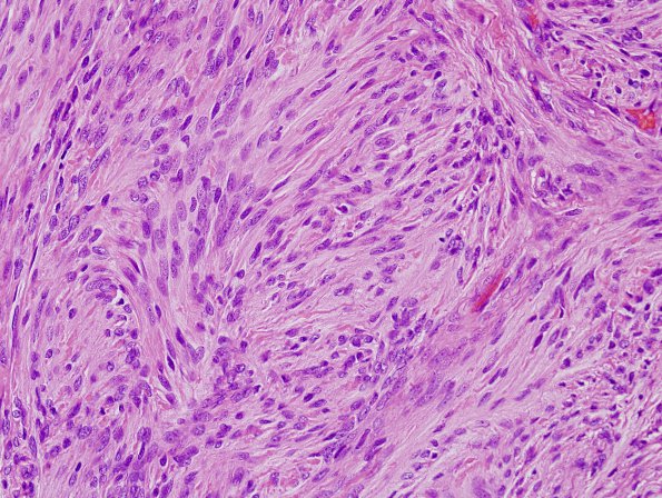 5B4 Meningioma, transitional (fibrous) (Case 5) H&E 5.jpg