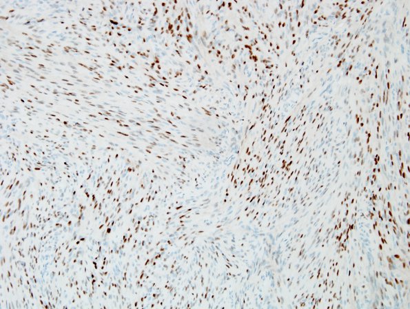 5C Meningioma, transitional (fibrous) (Case 5) PR 1.jpg