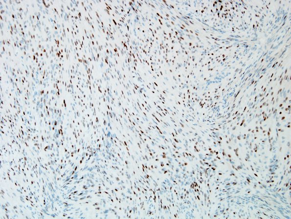 5C Meningioma, transitional (fibrous) (Case 5) PR 4.jpg