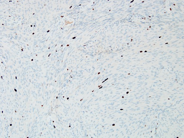 5D Meningioma, transitional (fibrous) (Case 5) Ki67.jpg