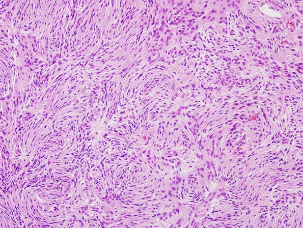 6A1 Meningioma, atypical (Case 6) H&E 2