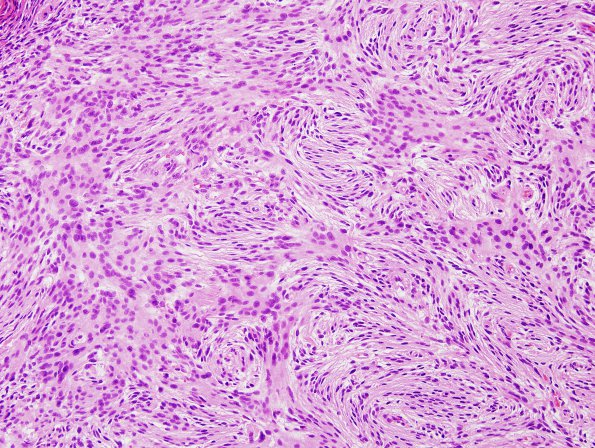 6A2 Meningioma, atypical (Case 6) H&E 3