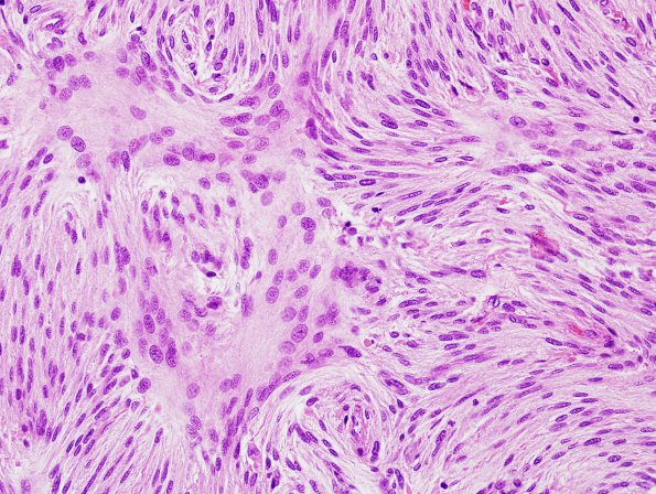 6A3 Meningioma, atypical (Case 6) H&E 1