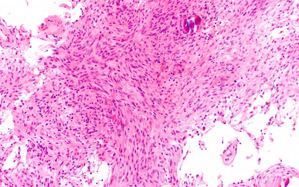 7B Meningioma, fibroblastic (Case 7) H&E 20X