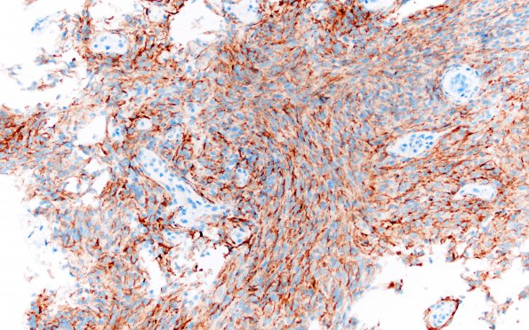 7C Meningioma, fibroblastic (Case 7) EMA 20X