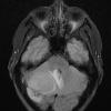 8A1 Meningioma, fibroblastic (Case 8) FLAIR - Copy