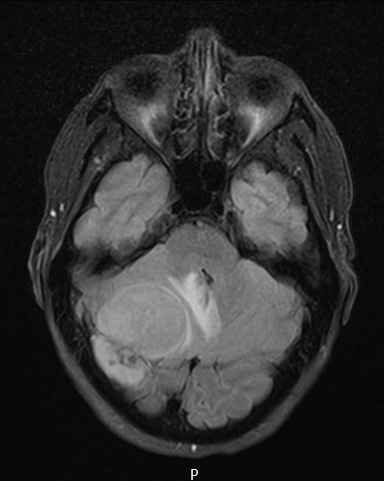 8A1 Meningioma, fibroblastic (Case 8) FLAIR - Copy