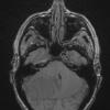 8A2 Meningioma, fibroblastic (Case 8) T1noC - Copy