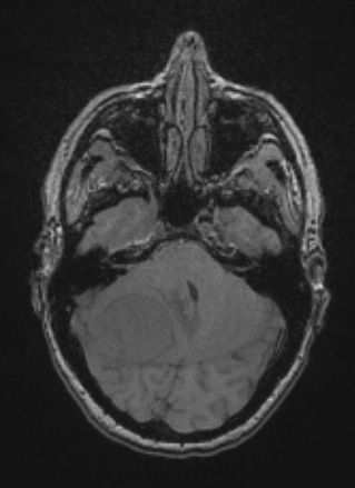 8A2 Meningioma, fibroblastic (Case 8) T1noC - Copy