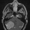 8A3 Meningioma, fibroblastic (Case 8) T1W - Copy