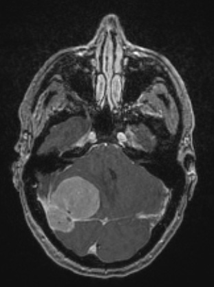 8A3 Meningioma, fibroblastic (Case 8) T1W - Copy